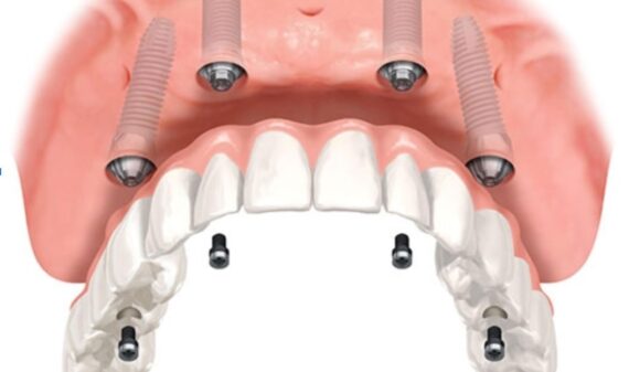 all-on-four Implants Brickell