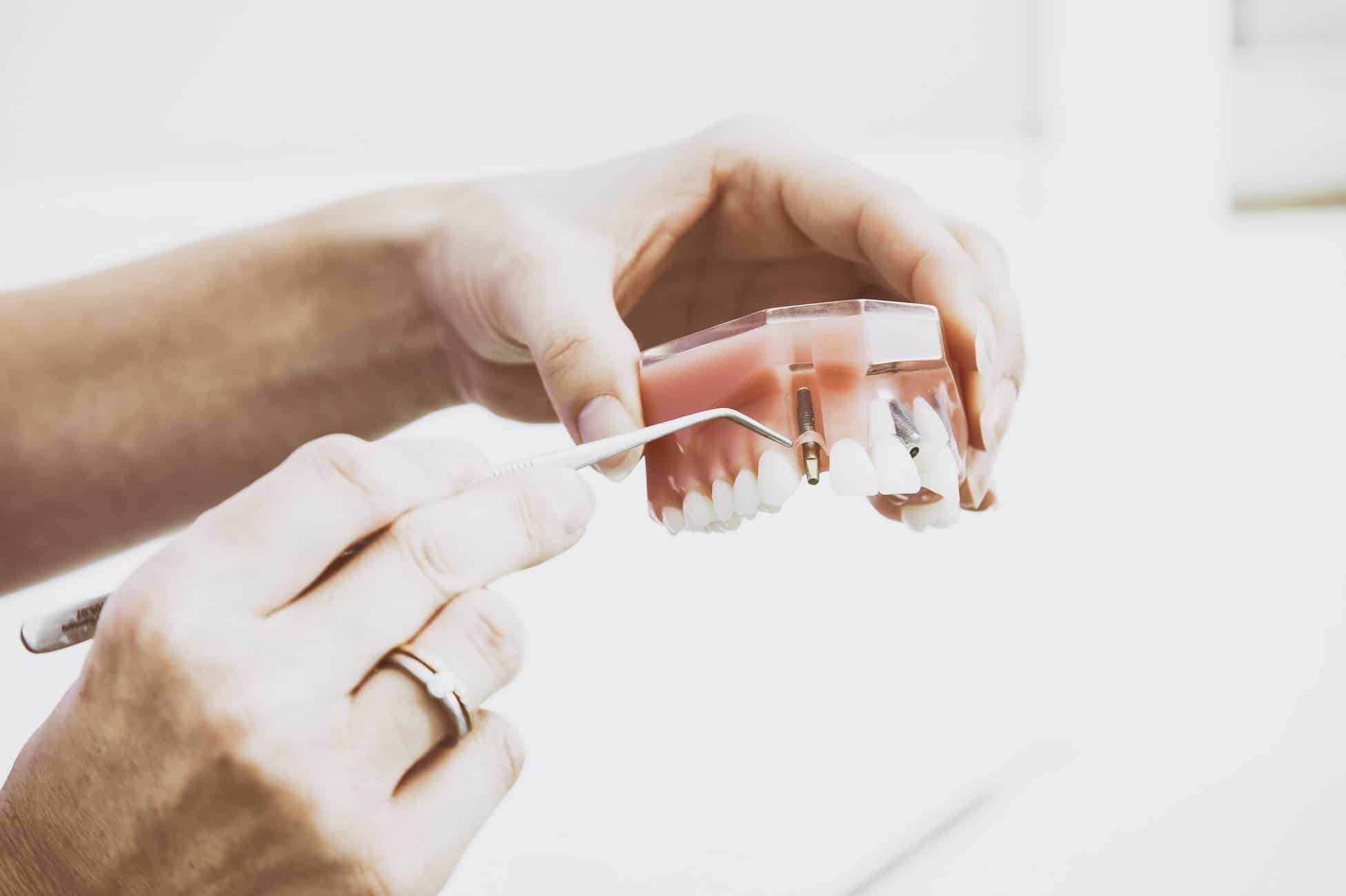 Implantes dentales brickell