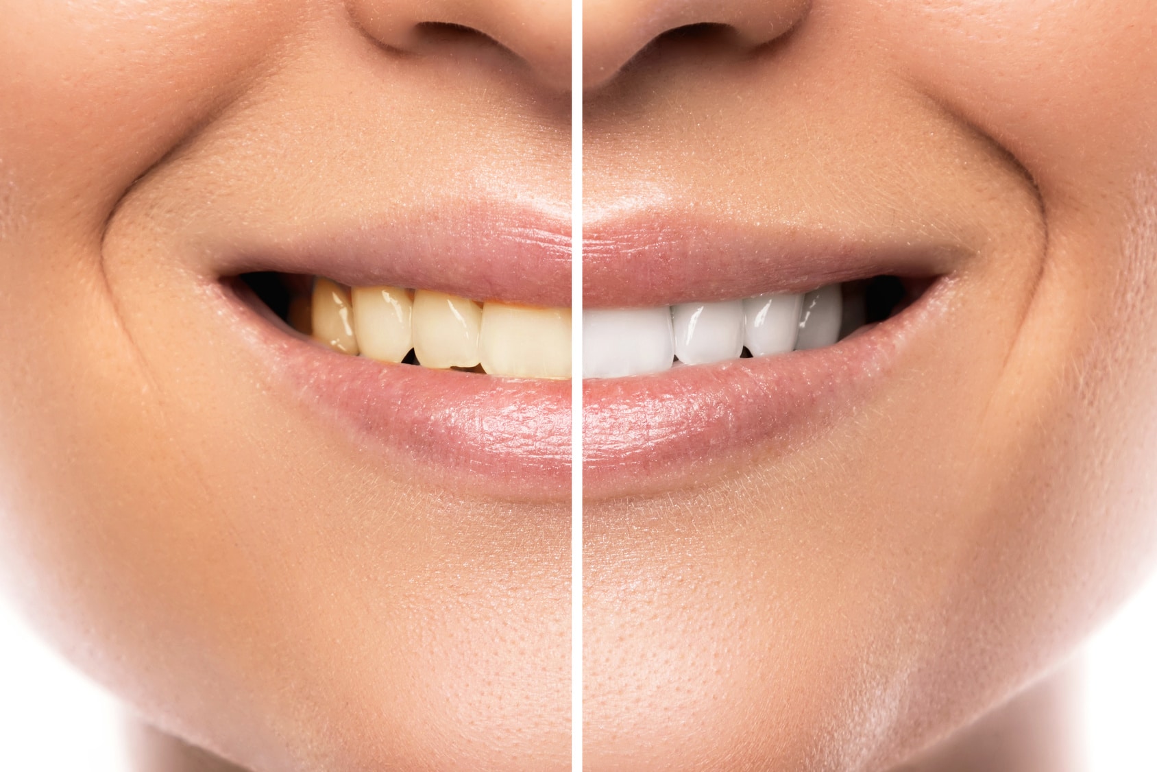 at-home-teeth-whitening-miami-fl-dentist-brickell-dental-general