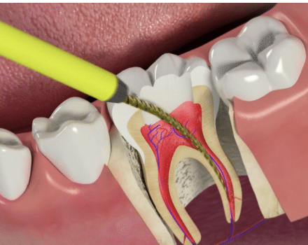 Root Canal Procedure in Brickell