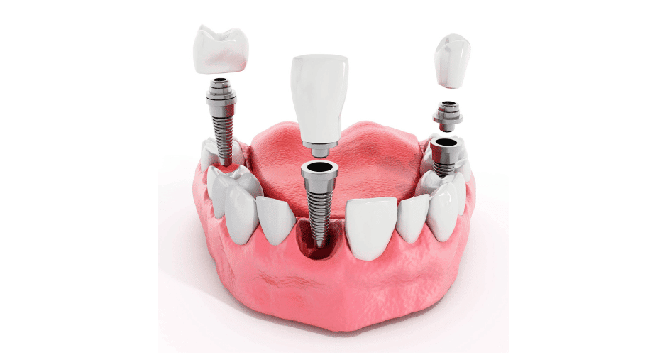 Myths about dental implants