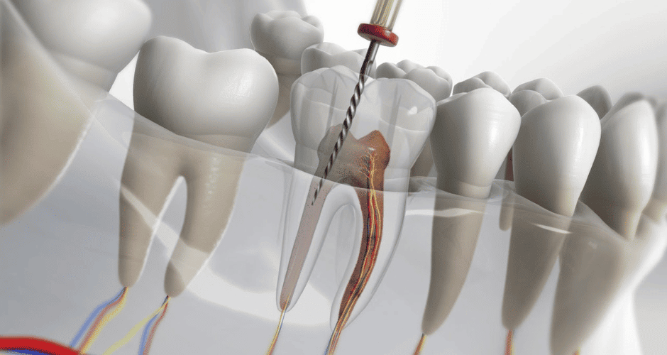 tooth nerve removal