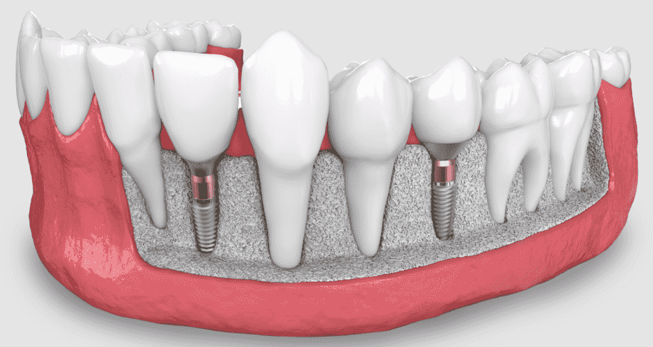 Placing a dental implant at Brickell Dental Care
